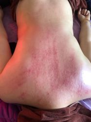 点击看大图 -莲芸拔罐减肥