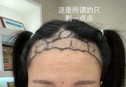 点击看大图 体验前-大麦微针植发全国连锁