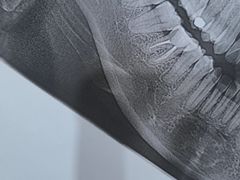 -上海仁爱医院口腔科 · 种植