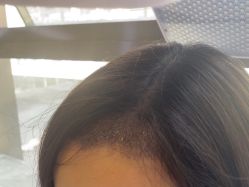 -碧莲盛·不剃发植发