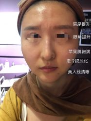 光SPA射频V小脸-光SPA科技美肤