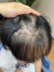 体验前-大麦微针植发全国连锁