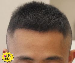 -大麦微针植发丨全国连锁