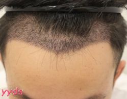 -大麦微针植发丨全国连锁