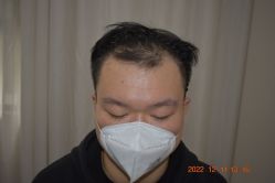 -大麦微针植发全国连锁