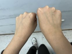体验前-嘉和医学脱毛中心
