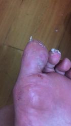 点击看大图 -德哥灰指甲脚气甲沟炎跖疣护理