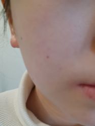 体验后-颜蕾医美黄金微针水光美肤玻尿酸抗衰中心