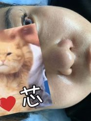 -爱莎扁平疣·汗管瘤·斑痣中心