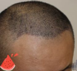 -大麦微针植发丨全国连锁