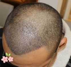 -大麦微针植发丨全国连锁