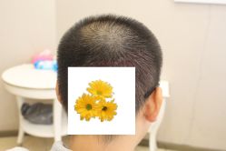 -大麦微针植发丨全国连锁