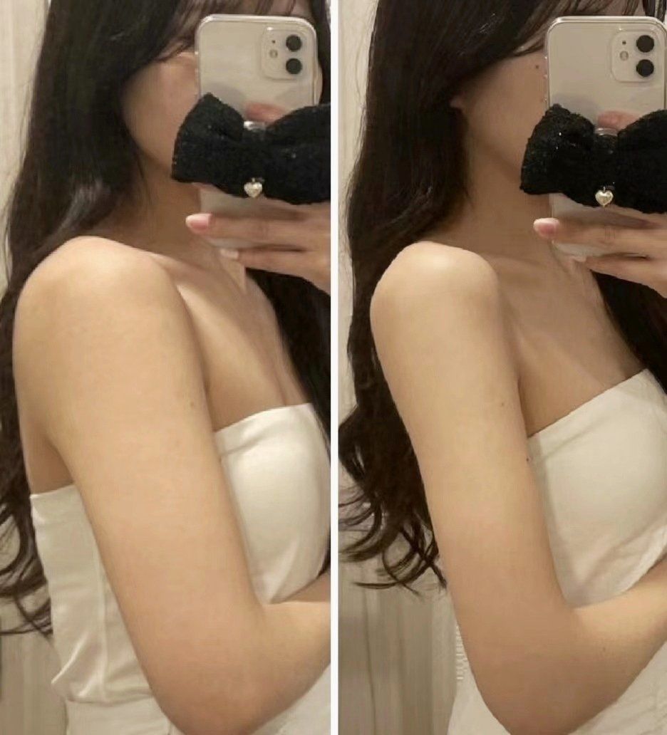 手臂吸脂