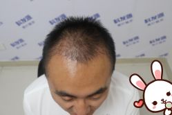 -大麦微针植发丨全国连锁