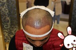 点击看大图 -大麦微针植发丨全国连锁