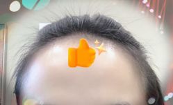 -大麦微针植发全国连锁