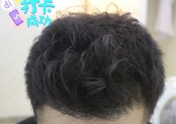 -大麦微针植发全国连锁