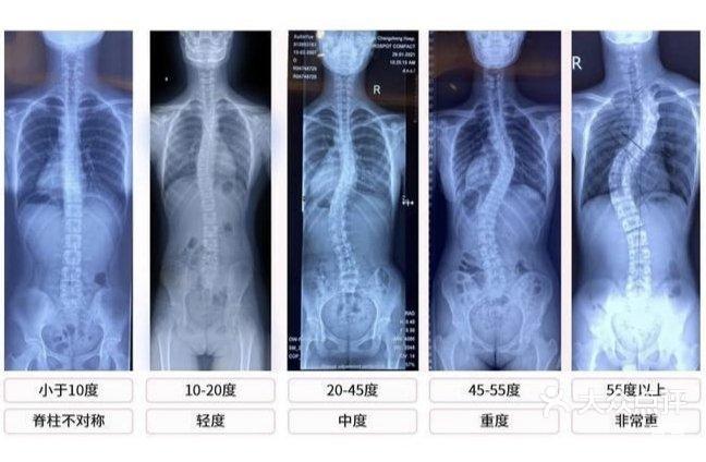 脊柱侧弯lenke分型图谱图片