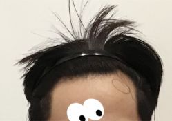 -大麦微针植发全国连锁