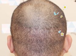 -大麦微针植发全国连锁