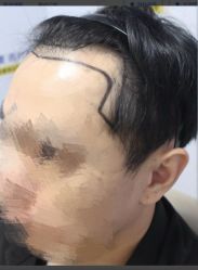 -大麦微针植发丨全国连锁