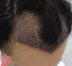 -大麦微针植发丨全国连锁