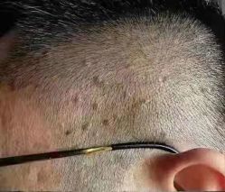 -北京美痣堂古方祛痣斑疣瘊