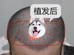 -大麦微针植发全国连锁