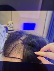 -碧莲盛·不剃发植发