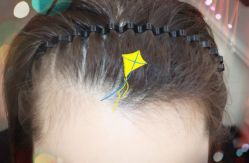 -大麦微针植发全国连锁