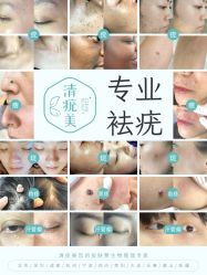 -清疣美疣·痣·斑净肤中心