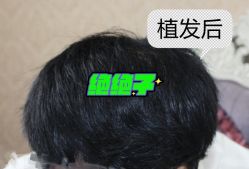 -大麦微针植发全国连锁