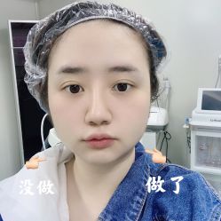 体验后-成都大华医学美容医院