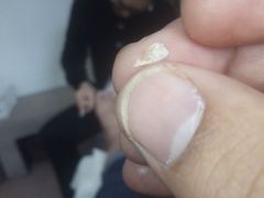 -祖传修脚甲沟炎灰指甲鸡眼