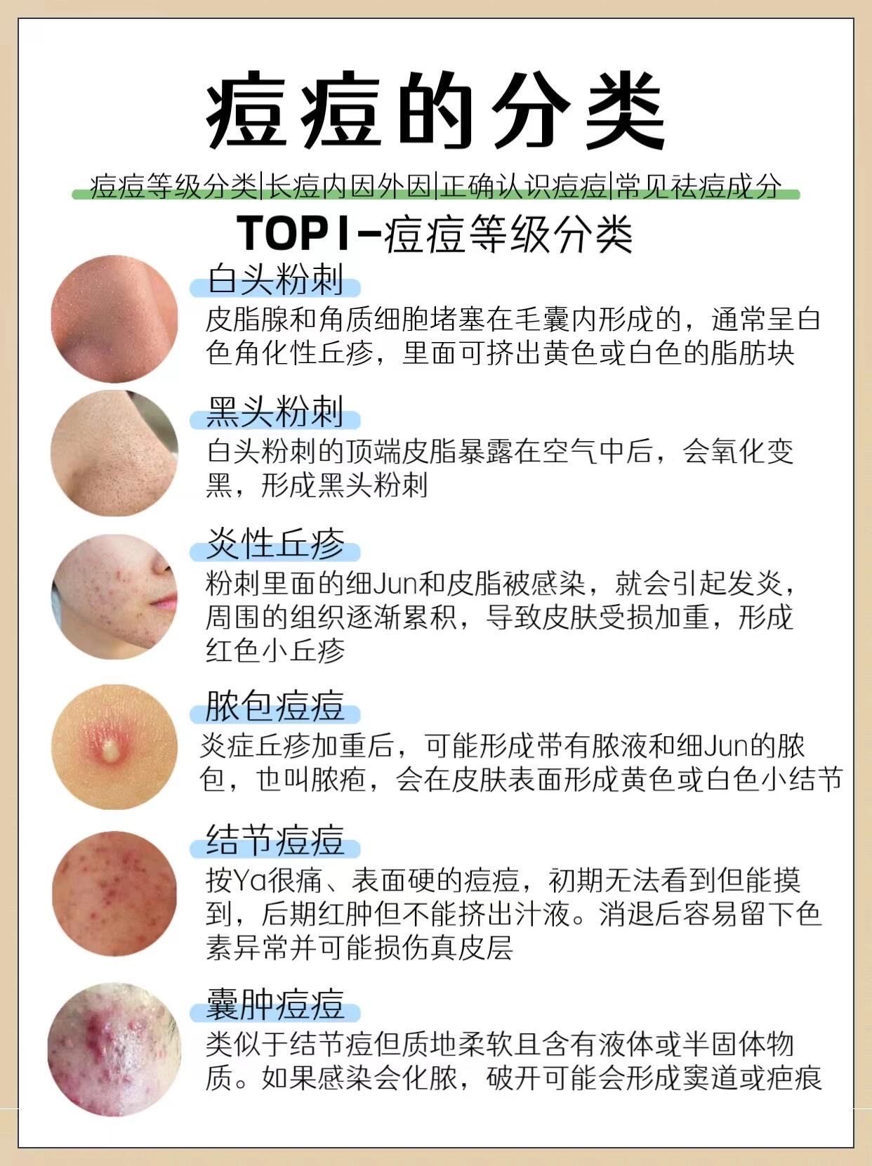 痘痘的分类,不同类型长痘科