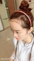 -大麦微针植发丨全国连锁