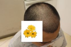 -大麦微针植发丨全国连锁