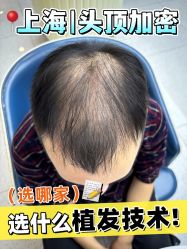 -大麦微针植发丨全国连锁