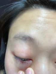 体验后-南京健丽·去眼袋医疗美容机构