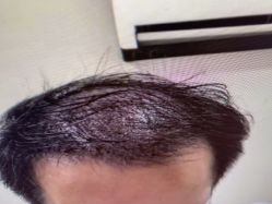 -碧莲盛·不剃发植发