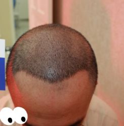 -大麦微针植发丨全国连锁