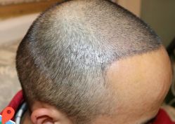 -大麦微针植发丨全国连锁