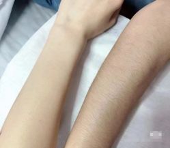 -薇兰专业脱毛连锁机构