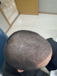 -大麦微针植发丨全国连锁