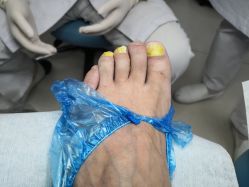 -派恩宜灰指甲鸡眼嵌甲手足癣