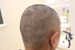 -大麦微针植发丨全国连锁