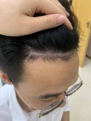 -大麦微针植发丨全国连锁