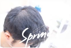 体验后-大麦微针植发全国连锁