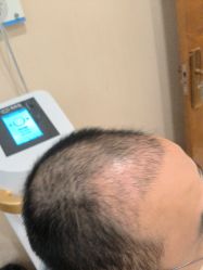 -碧莲盛·不剃发植发