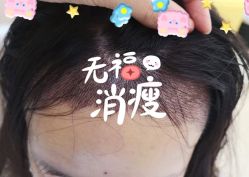 -大麦微针植发全国连锁